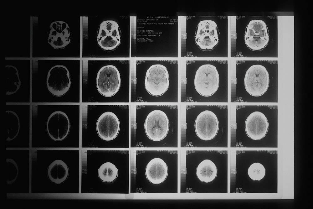 Advanced Neurosurgery in Turkey — Neurology & Neurosurgery, VelaCare Turkey